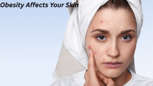 Obesity Affects Your Skin